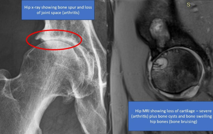 Xray showing significant amount of sub-chondral edema and BMLs in addition to large cysts in her bone.